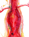 Abdominal Aneurysm Print Watercolor