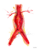 Abdominal Aneurysm Print Watercolor