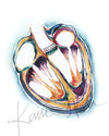 Heart Valve Replacement Watercolor Print