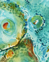 Basal Cell Carcinoma Watercolor Print