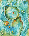 Basal Cell Carcinoma Watercolor Print