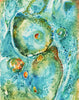 Basal Cell Carcinoma Watercolor Print