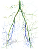 Unframed watercolor painting of two angiograms combined into one. The painting shows the before of a blocked iliac artery and an after, unblocked iliac artery.