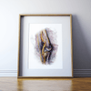 Deep Vein Thrombosis Watercolor Print