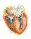 Hypertrophic Cardiomyopathy Heart Watercolor Print