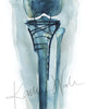 Unframed watercolor painting of a surgically repaired knee the hardware used to fix it.