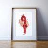 Thoracic Aneurysm Print Watercolor